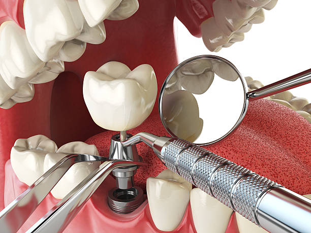 Best Knocked-Out Tooth (Avulsed Tooth) Treatment in Washington, IA